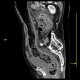 Pancolitis, colitis, severe: CT - Computed tomography